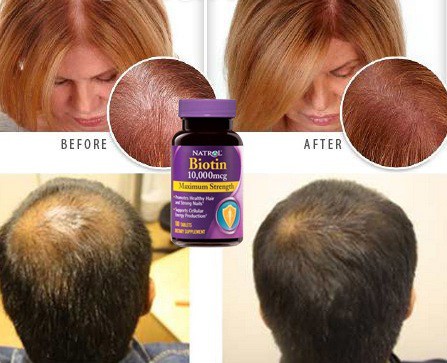 hieu-qua-sau-khi-su-dung-vien-uong-ngan-rung-toc-biotin viên uống ngăn rụng tóc, hỗ trợ mọc tóc Biotin 1000mcg